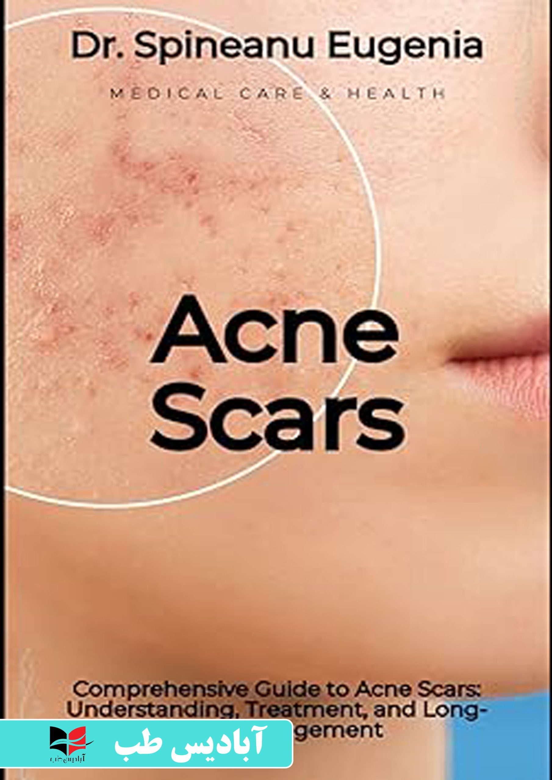 Comprehensive Guide to Acne Scars: Understanding, Treatment, and Long 